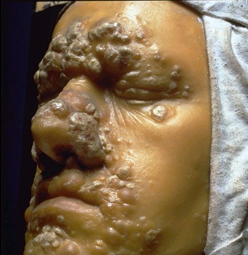 Syphilis+sores+on+mouth