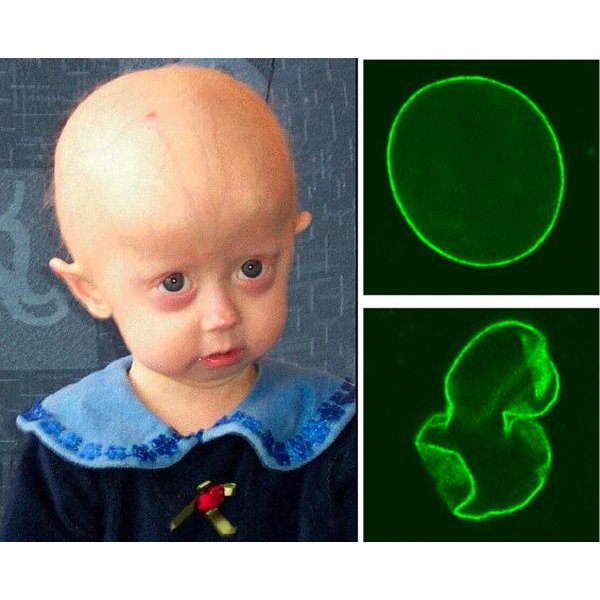  ipsc model Clinical trialsin march , the main title Gilford+progeria