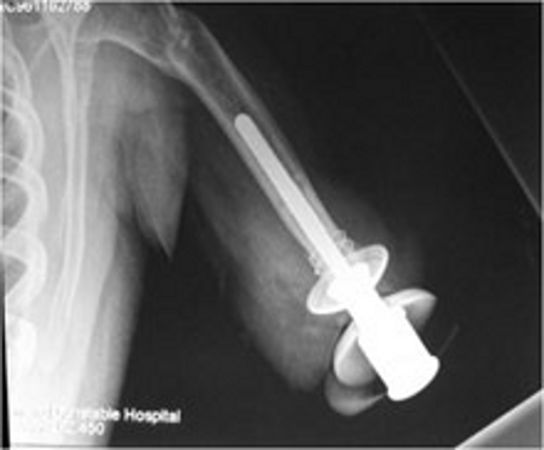Hip joint replacement: medlineplus medical encyclopedia