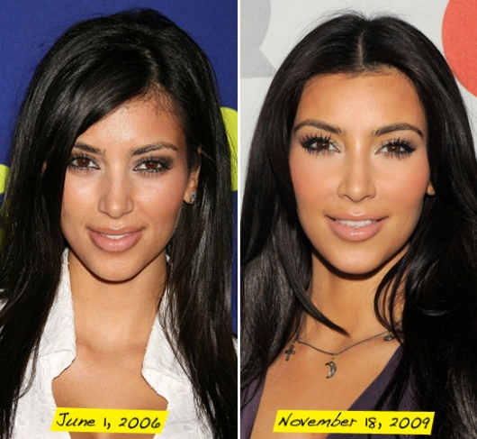 can find many of pictures of Kim Kardashian "Before" and "After" Plastic