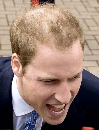 prince williams hairline. prince william hair thinning.