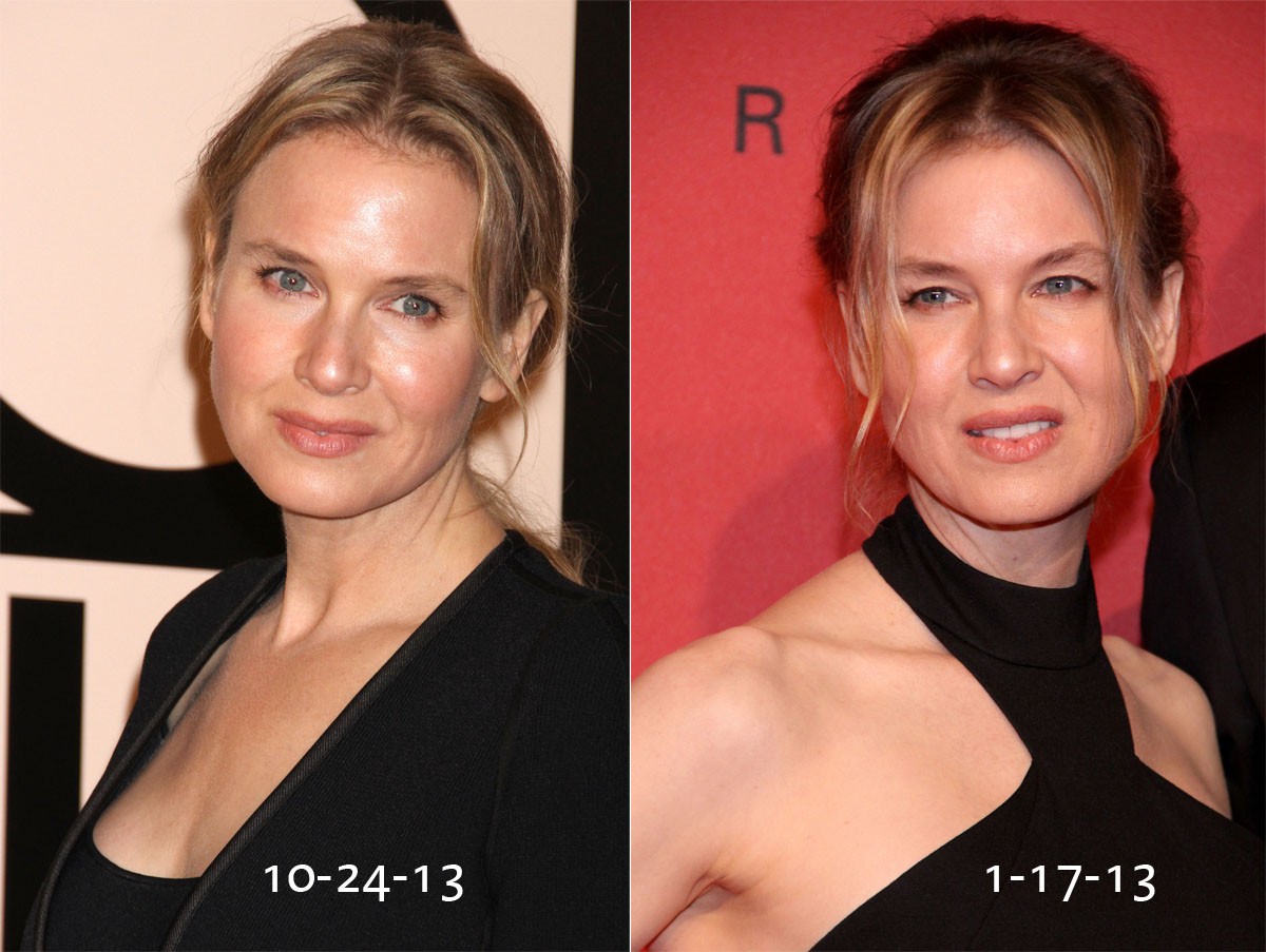 What Happened to Renee Zellweger’s Face, and Why Do We Care?
