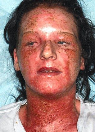Woman-Ends-Up-in-Burns-Unit-After-Allergic-Reaction-to-Hair-Dye-2.jpg
